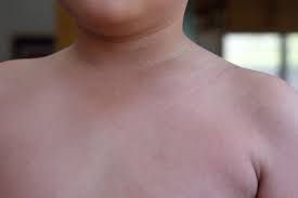 Ban đỏ ở trẻ em - Hình ảnh minh họa